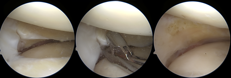 Meniskusteilresektion